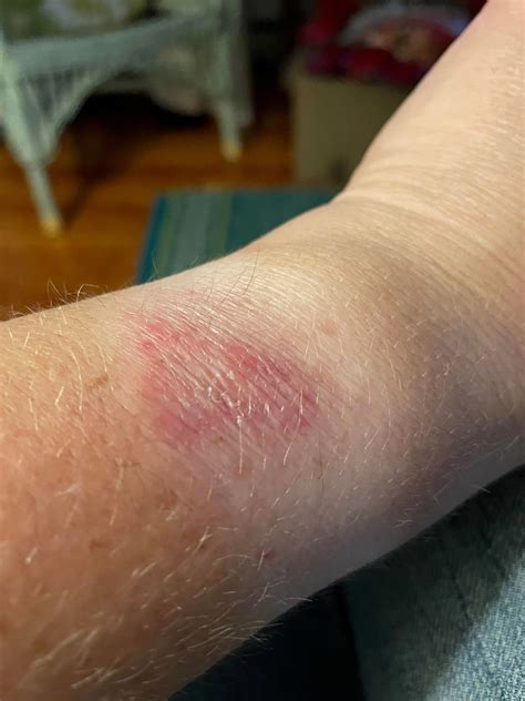 rash from wearing apple watch